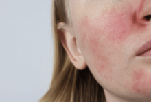 Rosacea: Symptoms and Management Strategies