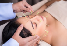 The Role of Facial Acupuncture in Stress Relief