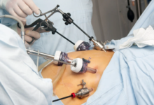 How Gastric Sleeve Surgery Helps Combat Fatty Liver Disease