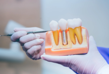 Long-Term Value: Why Dental Implants Are A Smart Investment?