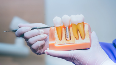 Long-Term Value: Why Dental Implants Are A Smart Investment?