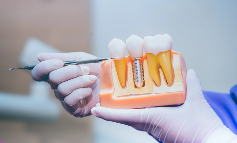 Long-Term Value: Why Dental Implants Are A Smart Investment?