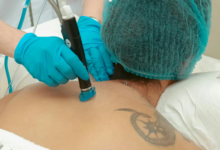 How Cold Laser Treatment Helps Speed Up Healing After Injury