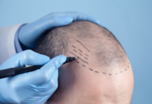 Is Dubai the Best Place for a Hair Transplant in 2025?