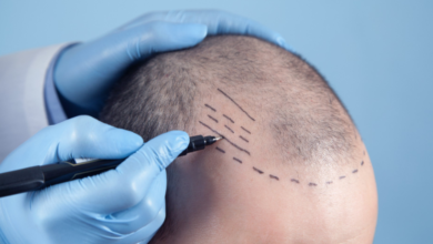 Is Dubai the Best Place for a Hair Transplant in 2025?