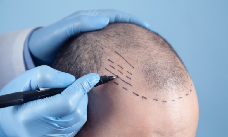 Is Dubai the Best Place for a Hair Transplant in 2025?