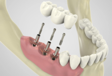 4 Essential Steps In The Dental Implant Placement Process