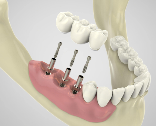 4 Essential Steps In The Dental Implant Placement Process