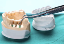 How Guided Surgery Enhances Precision In Implant Dentistry