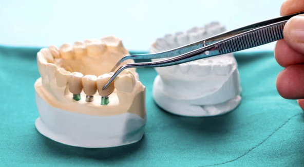 How Guided Surgery Enhances Precision In Implant Dentistry